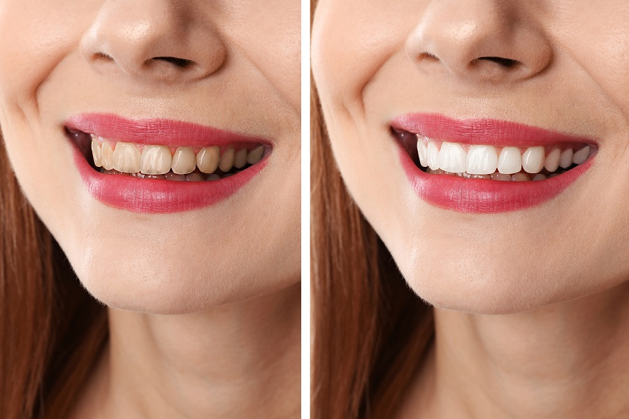 Teeth Whitening: Simple, Safe And Effective