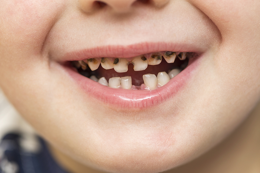 Take Care Of Your Teeth To Keep Decay Away!