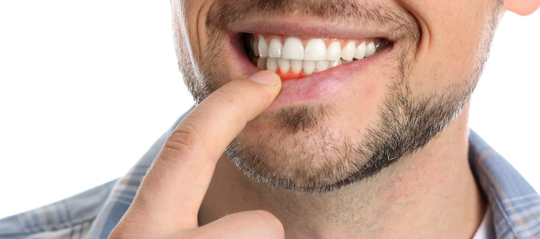 Take These Actions To Avoid Bleeding Gums